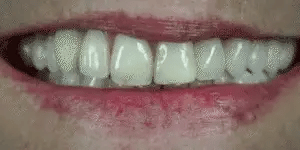 LumaGrin™ Snap-On Cosmetic Veneers – Temporäres Lächeln für Fotos & Events
