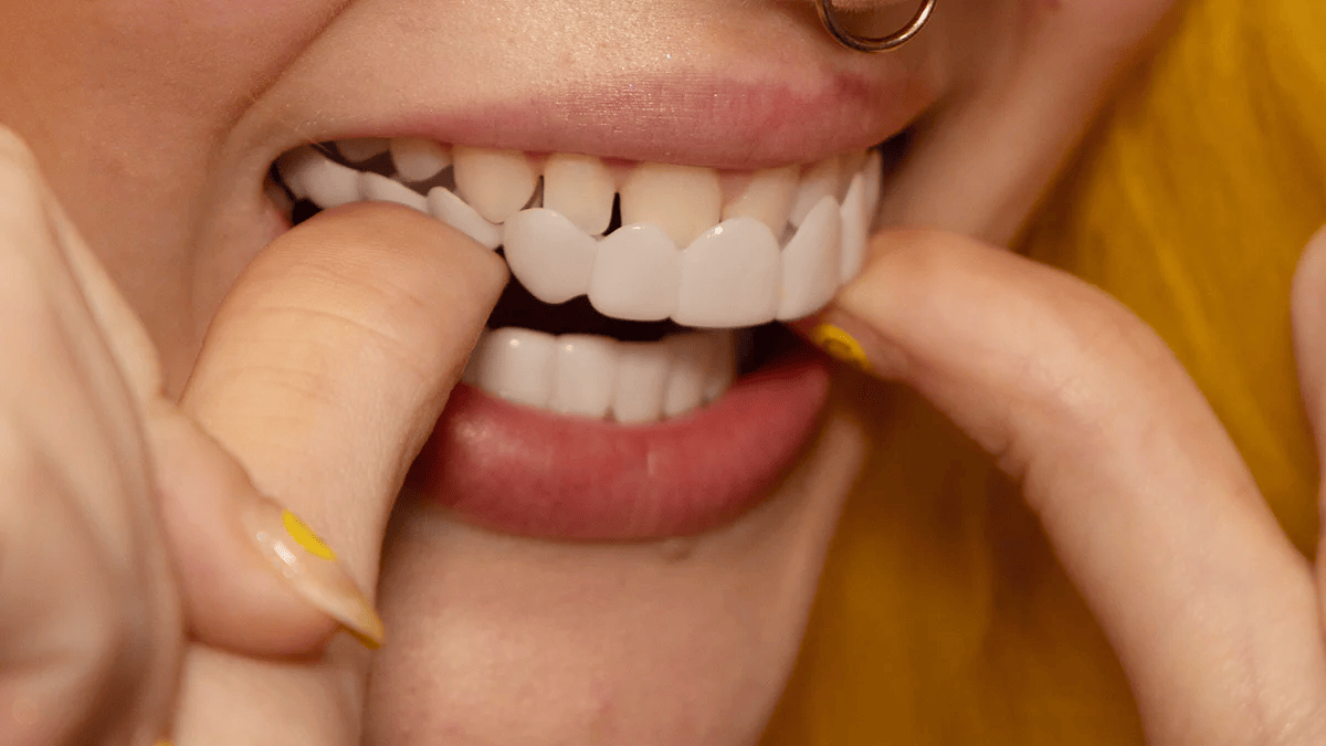 LumaGrin™ Snap-On Cosmetic Veneers – Temporäres Lächeln für Fotos & Events