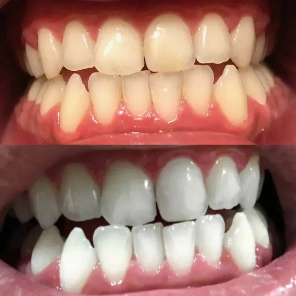 DiamondSmile™ – Zahnaufhellungsstift (1+1 KOSTENLOS)