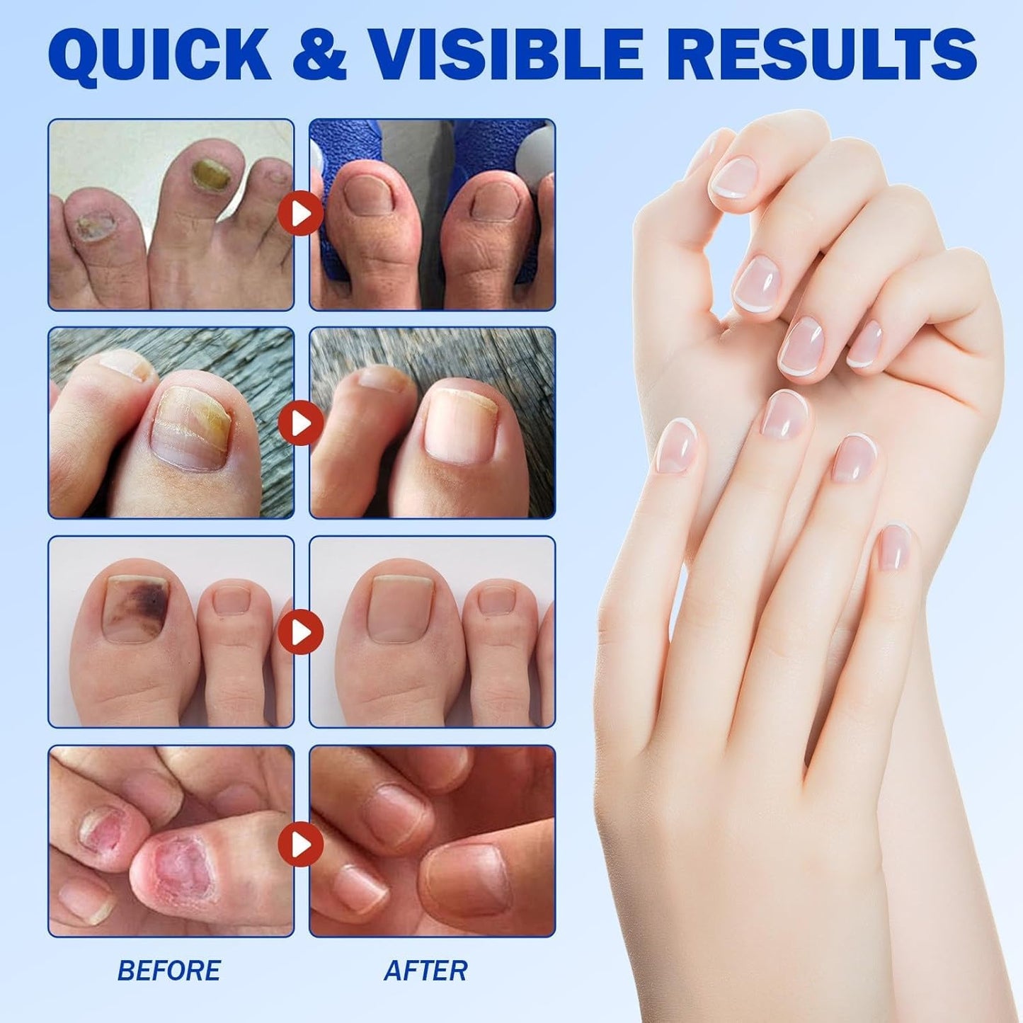 PureNail™ - Optimale Wiederherstellung Ihrer Nägel | 50% RABATT