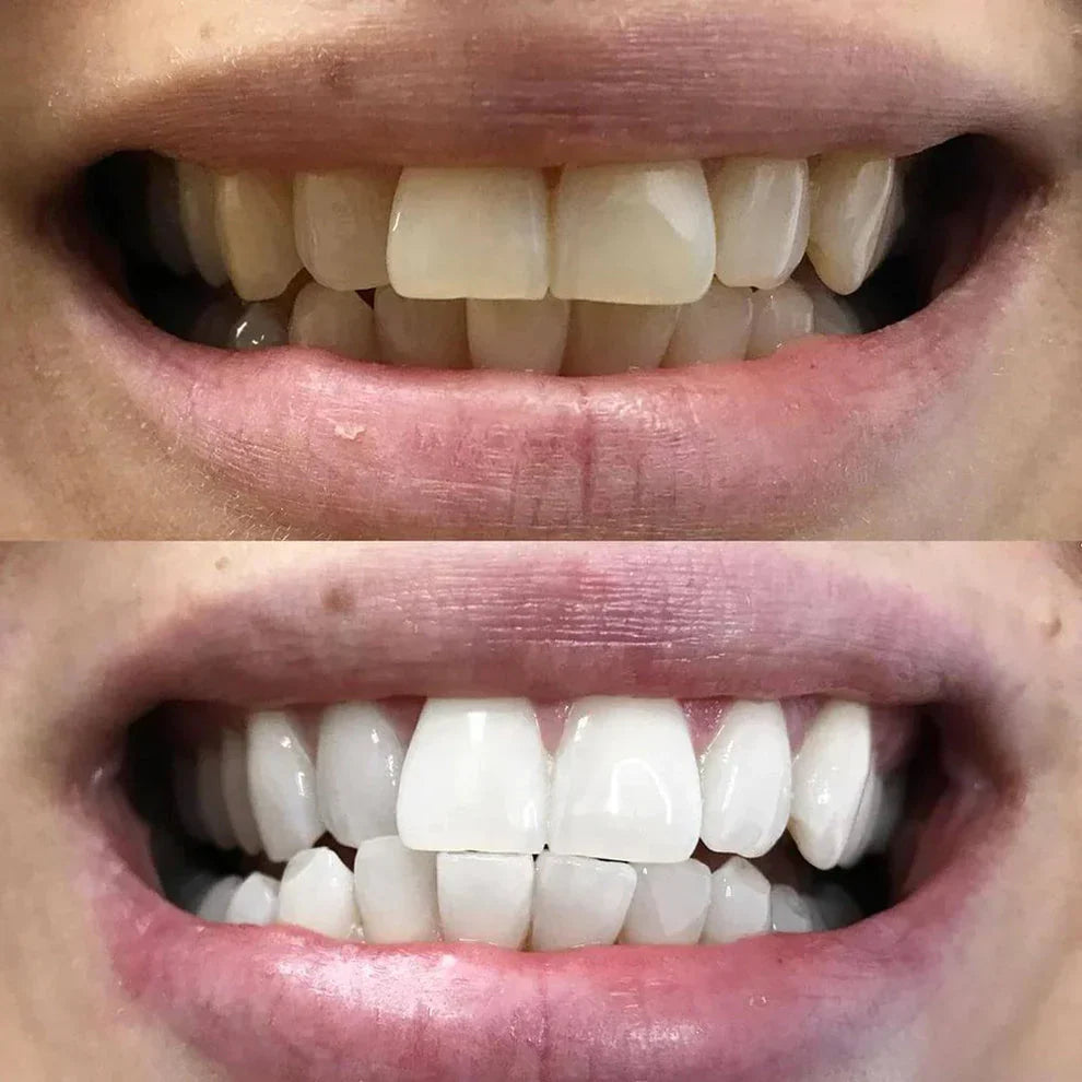 DiamondSmile™ – Zahnaufhellungsstift (1+1 KOSTENLOS)