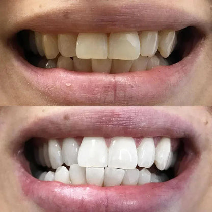 DiamondSmile™ – Zahnaufhellungsstift (1+1 KOSTENLOS)