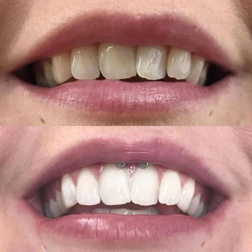DiamondSmile™ – Zahnaufhellungsstift (1+1 KOSTENLOS)