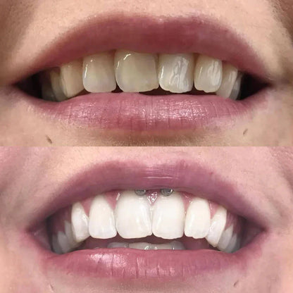 DiamondSmile™ – Zahnaufhellungsstift (1+1 KOSTENLOS)
