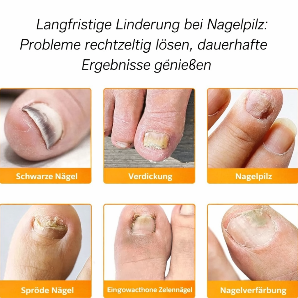 FungalPatch™ | Gepflegte Nägel ohne Aufwand | 2+1 GRATIS