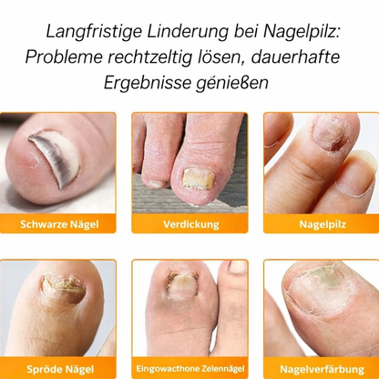 FungalPatch™ | Gepflegte Nägel ohne Aufwand | 2+1 GRATIS