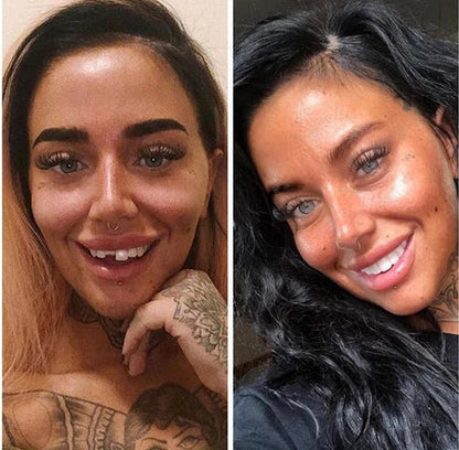LumaGrin™ Snap-On Cosmetic Veneers – Temporäres Lächeln für Fotos & Events