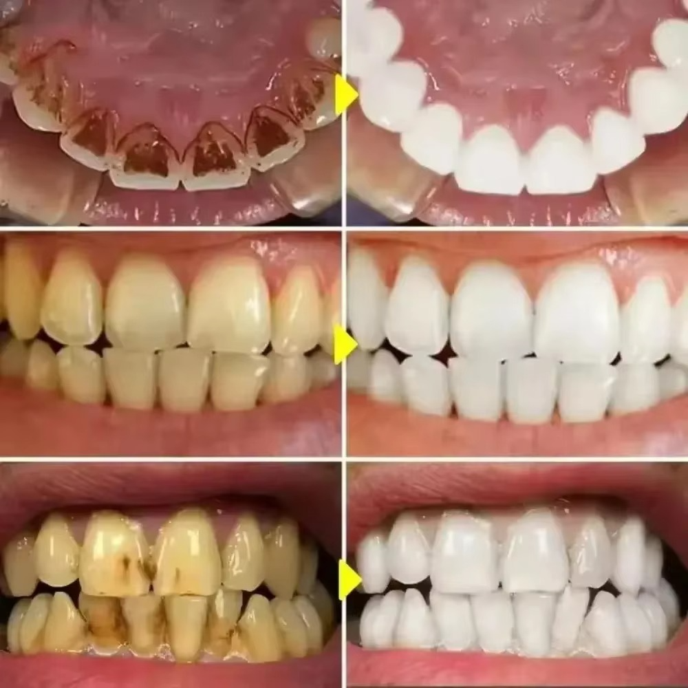 DiamondSmile™ – Zahnaufhellungsstift (1+1 KOSTENLOS)