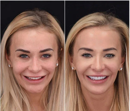LumaGrin™ Snap-On Cosmetic Veneers – Temporäres Lächeln für Fotos & Events