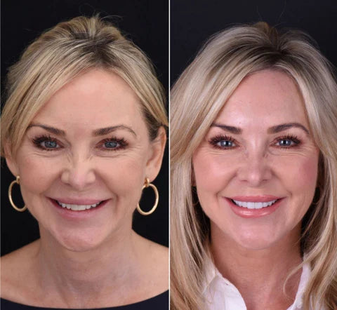 LumaGrin™ Snap-On Cosmetic Veneers – Temporäres Lächeln für Fotos & Events
