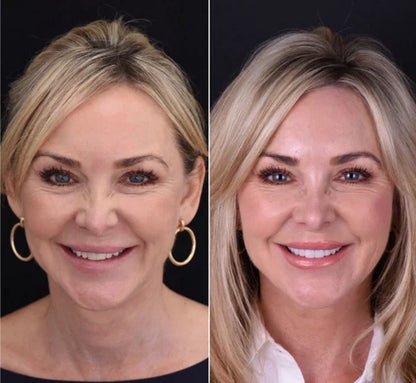 LumaGrin™ Snap-On Cosmetic Veneers – Temporäres Lächeln für Fotos & Events