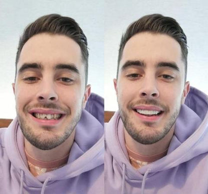 LumaGrin™ Snap-On Cosmetic Veneers – Temporäres Lächeln für Fotos & Events